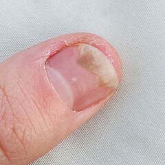 Close-Up of Fingernail Showing Health Condition