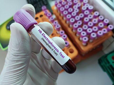 Scientist holds Blood samples for Hb electrophoresis test.  Blood collection tube for Hemoglobin electrophoresis test in the laboratory background.