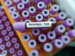 Blood sample for karyotyping test. Healthcare and medical test concept.