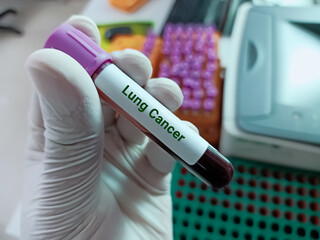Scientist holds blood sample for Lung Cancer test with laboratory background.