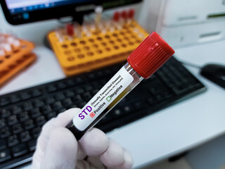 Doctor hold Blood sample for STD (Sexually Transmitted Disease ) Test. Positive result test tube.