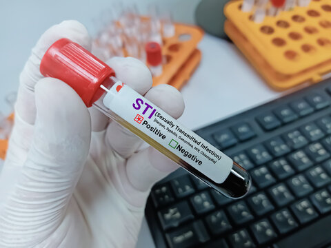 Doctor hold Blood sample for STI (Sexually Transmitted Infection) Test. Positive result test tube.