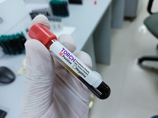 Scientist hold blood sample for TORCH positive result test tube. Toxoplasma, Rubella,...