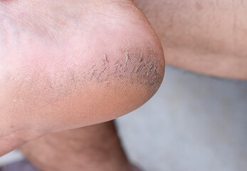 Fototapeta premium Close up cracked heel further deep cracks and dry flaky skin