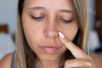 Young woman pointing at her sunburned nose with peeling skin. The flaking skin highlights the...