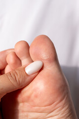Young woman showing a callus on her big toe. The thickened skin highlights the effects of friction and pressure. A detailed view of foot care and common skin conditions. Vertical shot