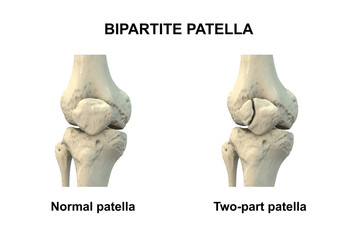 Bipartite patella, a condition where the kneecap has an unfused accessory ossification center, usually superolateral, 3D illustration.