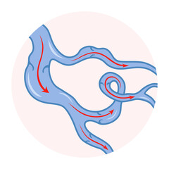 Varicose veins. Blue blood vessel visible through the skin. Vascular disease diagnostic and treatment. Venous insufficiency medical