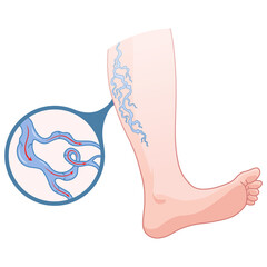 Varicose veins. Blue blood vessel visible through the skin, abnormally swollen leg. Vascular disease diagnostic and treatment. Venous insufficiency medical disease