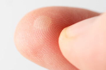 Injured with blister human finger