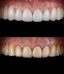 emax ceramic veneers