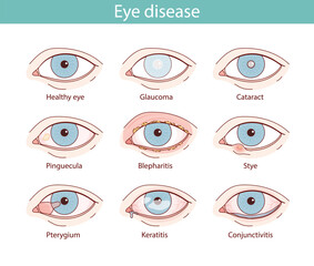set of illustrations of eyes with different diseases. vector anatomical illustration