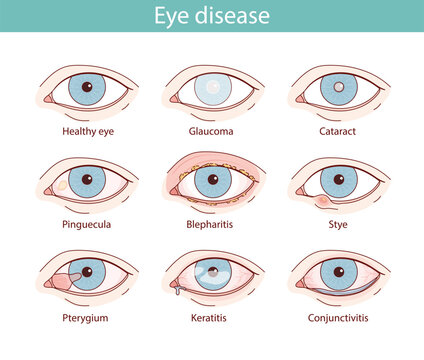 set of illustrations of eyes with different diseases. vector anatomical illustration