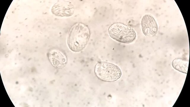 Schistosoma Spp. Parasite egg in human urine specimen under microscope. Urinary parasite