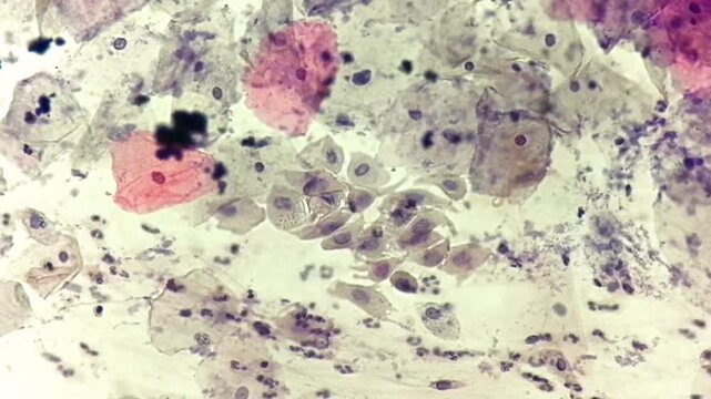 Photomicrographic footage of Paps smear: Inflammatory smear with HPV related changes. Cervical cancer. SCC