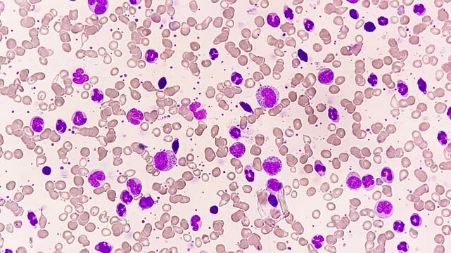 Micrographic footage showing Chronic myelogenous leukemia (CML), also known as chronic myeloid leukemia, is a cancer of the white blood cells. chronic granulocytic leukemia.