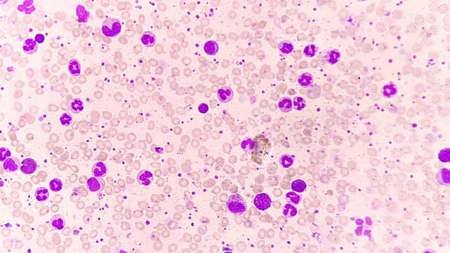 Micrographic footage showing Chronic myelogenous leukemia (CML), also known as chronic myeloid leukemia, is a cancer of the white blood cells. chronic granulocytic leukemia.