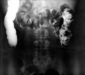 Real Barium enema images series. Three x-ray of the Lower gastrointestinal (GI) tract. Third special Radiography films of a man large intestine. (The first and second film in the portfolio).
