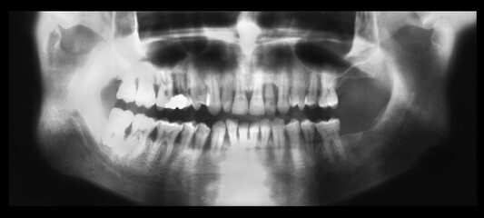 Orthopantomography (OPG) or Radiography of the oral cavity. Real Orthopantomogram or x-Ray film of dental arches of a man with signs of diffuse periodontitis and bone resorption of the root tips. 