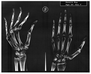 Real Radiograph of a woman hand. X-ray film of a normal 30-year-old woman hand.
