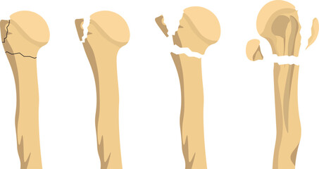 The Neer Classification categorized proximal humerus fractures based on the number of displaced fracture parts of the humeral head, greater tuberosity, lesser tuberosity, and shaft.