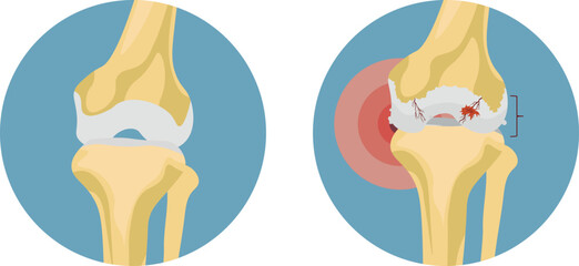 Osteoarthritis is the most common form of arthritis, characterized by the gradual degeneration of joint cartilage and underlying bone, leading to joint pain, stiffness, swelling, and reduced mobility