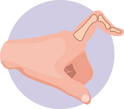 Boutonniere deformity is a finger deformity that results from injury or dysfunction of the central slip of the extensor tendon at the proximal interphalangeal (PIP) joint. 