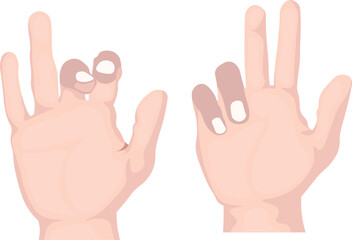 Nerve injury of the hand refers to damage to the sensory or motor nerves that control movement and sensation in the hand and fingers affecting median, ulnar, and radial nerves