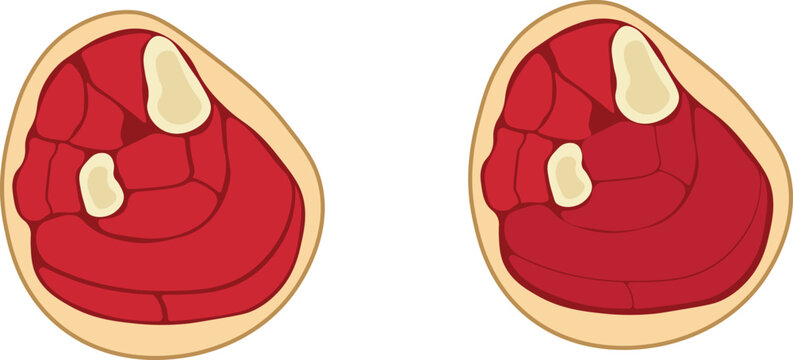 increased pressure within the superficial or deep posterior compartments of the leg, typically affecting the calf muscles due to trauma, fractures, overuse, or vascular compromise