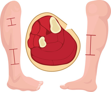 Fasciotomy is a surgical procedure used to relieve tension or pressure within a muscle compartment, most commonly performed to treat acute compartment syndrome