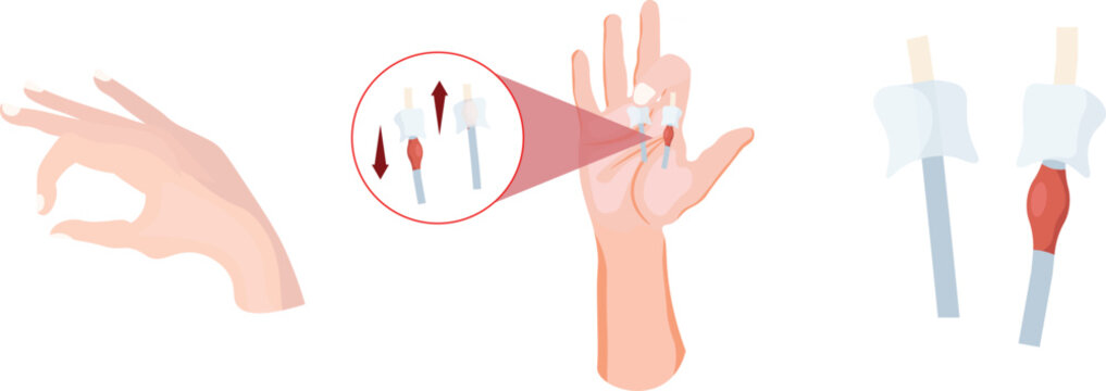 Trigger finger, also known as stenosing tenosynovitis, is a condition in which a finger becomes stuck in a bent position and then snaps straight
