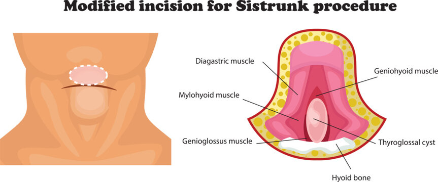 The Sistrunk procedure is a surgical technique used to remove a thyroglossal duct cyst, a common congenital neck mass.