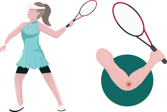 Tennis elbow is a painful condition caused by overuse or repetitive strain of the forearm muscles and tendons, particularly around the lateral epicondyle of elbow