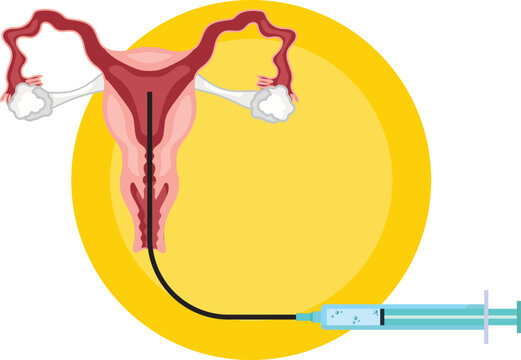 Intrauterine insemination involves directly placing sperm into a woman&rsquo;s uterus to facilitate fertilization and increase the chances of pregnancy