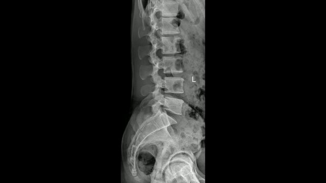 Human Lumbar Spine Lateral Radiograph Showing Straight Spine