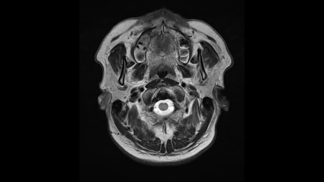 Axial view T2-weighted magnetic resonance imaging (MRI) scan of a normal brain.