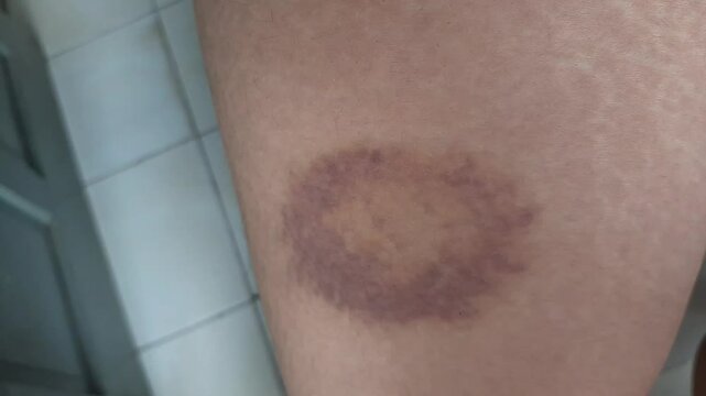 a bruise on the thigh