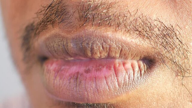 Healing and care tips for chapped lips in dry climates