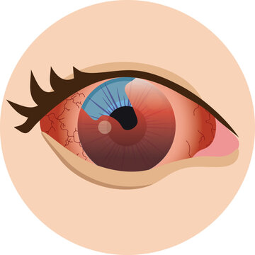hyphaema of the eye vector