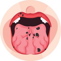 peutz jegher syndrome with hyperpigmentation on the mouth mucosa