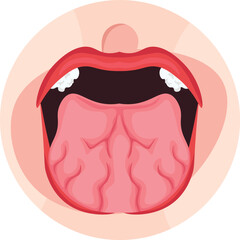 tongue fissure due to dry tongue