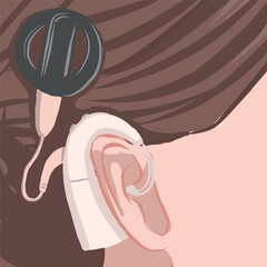 cochlear implant. Medical poster with device near ear close-up. Vector illustration