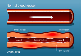 Vasculitis. Autoimmune disease.  Cross section of Blood vessel