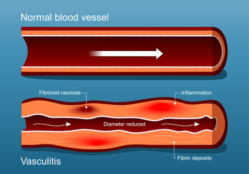Vasculitis. Autoimmune disease.  Cross section of Blood vessel