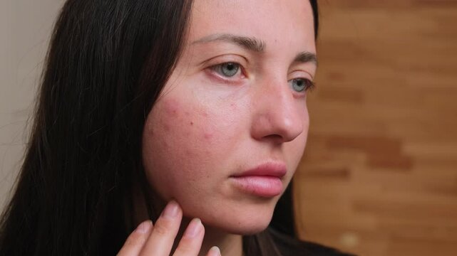 Young woman face with redness on cheeks, close-up. Skin problems, unhealthy skin with acne and pimples. Allergic red rashes. The concept of care for problem skin.