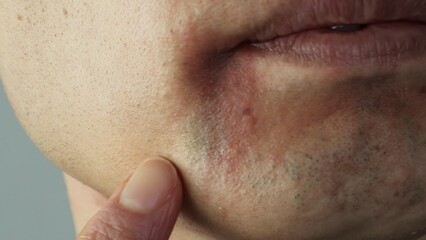 レーザー脱毛後の肌荒れを指差す日本人男性