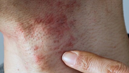 脱毛後の肌の炎症を指差す男性