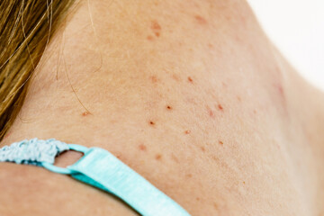 Fototapeta premium Woman with acne pimple on neck.