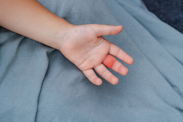 Children hand swollen from wasp sting, insect, reaction to poison