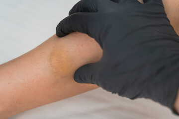 Doctors hand examining the woman leg with bruise, hematoma